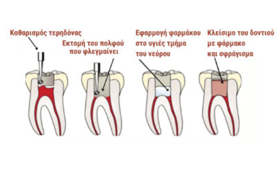 Pediatric Dentistry: Pulpotomy of a deciduous tooth